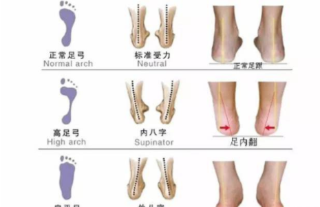 寶寶足內(nèi)翻怎么辦 寶寶足內(nèi)翻治療方法 寶寶足內(nèi)翻怎么辦 寶寶足內(nèi)翻治療方法