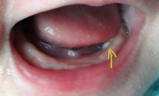 寶寶馬牙和鵝口瘡有什么不同  馬牙和鵝口瘡區(qū)別介紹