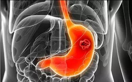 為什么癌癥一發(fā)現(xiàn)就是晚期了 死亡率最高的3種癌癥是什么