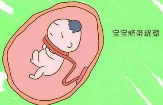 臍帶繞頸能順產(chǎn)嗎 臍帶繞頸兩周可以脫開嗎