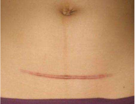 剖腹產(chǎn)疤痕增生怎么回事 疤痕增生用什么藥好