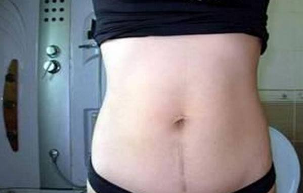 剖腹產(chǎn)疤痕增生怎么回事 疤痕增生用什么藥好