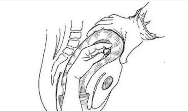 手剝胎盤是什么感覺 哪些產婦更容易手剝胎盤 手剝胎盤是什么感覺 哪些產婦更容易手剝胎盤