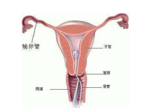 什么時(shí)候做輸卵管通液合適 輸卵管通液靠譜嗎