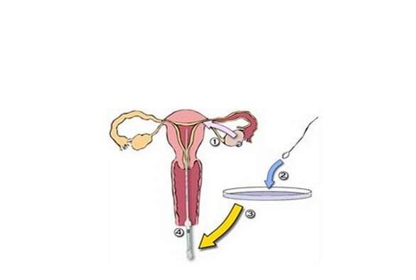 什么時(shí)候做輸卵管通液合適 輸卵管通液靠譜嗎