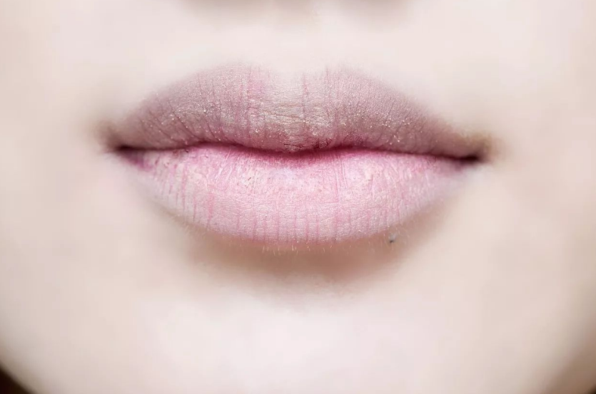 孩子上火了怎么處理比較好 孩子上火癥狀正確處理方法