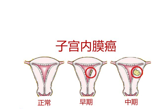子宮內(nèi)膜癌做什么檢查 如何預(yù)防子宮內(nèi)膜癌