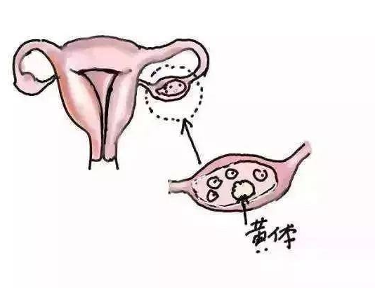 卵巢破裂是怎么回事 卵巢破裂對(duì)女性有什么危害