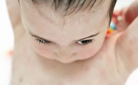 寶寶脾虛吃什么好  孩子脾虛食譜推薦