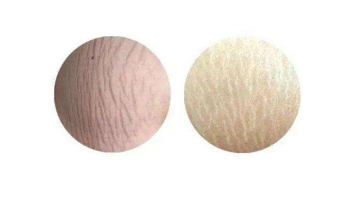 肥胖紋怎么消除 出現(xiàn)肥胖紋是怎么回事