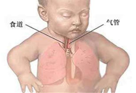 什么是新生兒胎糞吸入綜合征 如何預防胎糞吸入綜合征