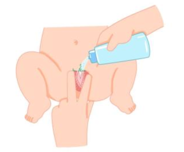 為什么4歲以下的女寶寶容易得小陰唇粘連 寶寶小陰唇粘連怎么預(yù)防 為什么4歲以下的女寶寶容易得小陰唇粘連 寶寶小陰唇粘連怎么預(yù)防