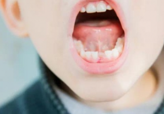 寶寶乳牙長歪了怎么辦  乳牙長歪的原因介紹