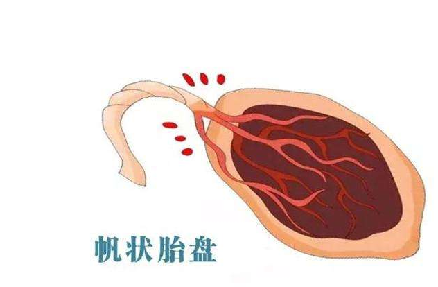 帆狀胎盤有什么危害 帆狀胎盤是什么原因引起的