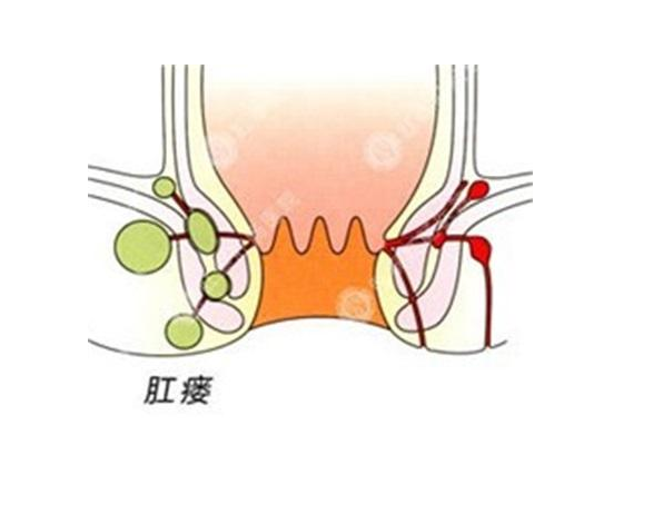 肛瘺和痔瘡有什么區別 肛瘺疾病有什么危害