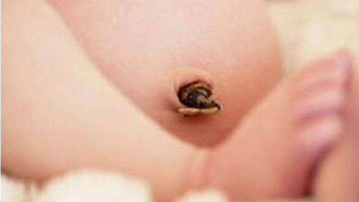 新生兒肚臍感染會導致敗血癥嗎 新生兒肚臍護理方法