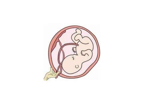 臍帶脫垂是什么意思 如何預防臍帶脫垂