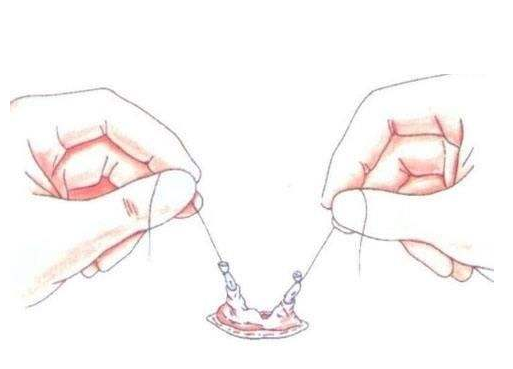 男性結扎能百分百避孕嗎 男性結扎后想生育還可以恢復嗎