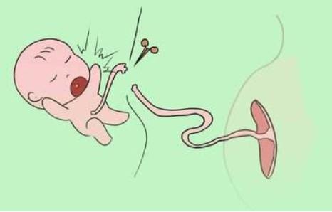 寶寶臍帶扭轉和睡姿有關嗎 寶寶臍帶扭轉是怎么回事