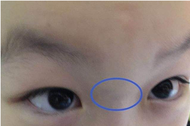 寶寶鼻梁上有青筋是不好帶嗎 寶寶鼻梁上有青筋怎么辦 寶寶鼻梁上有青筋是不好帶嗎 寶寶鼻梁上有青筋怎么辦