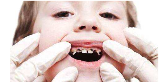 寶寶牙齒黑是怎么回事 寶寶牙齒發黑怎么辦