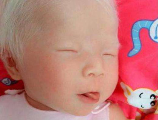 白化病產前檢查能查出來嗎 白化病能活多久 白化病產前檢查能查出來嗎 白化病能活多久