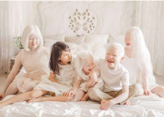 白化病產前檢查能查出來嗎 白化病能活多久 白化病產前檢查能查出來嗎 白化病能活多久