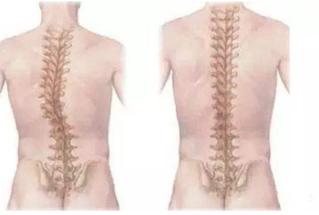 孩子脊柱側(cè)彎是怎么引起的 脊柱側(cè)彎的治療的黃金時期 孩子脊柱側(cè)彎是怎么引起的 脊柱側(cè)彎的治療的黃金時期