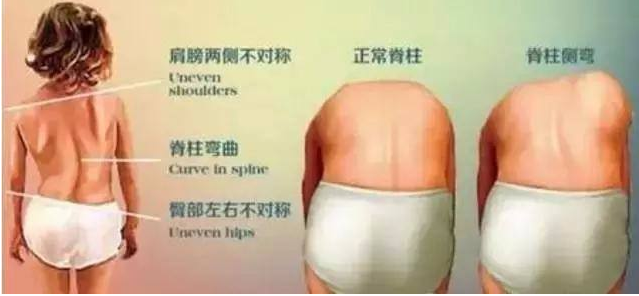 孩子脊柱側(cè)彎是怎么引起的 脊柱側(cè)彎的治療的黃金時期 孩子脊柱側(cè)彎是怎么引起的 脊柱側(cè)彎的治療的黃金時期