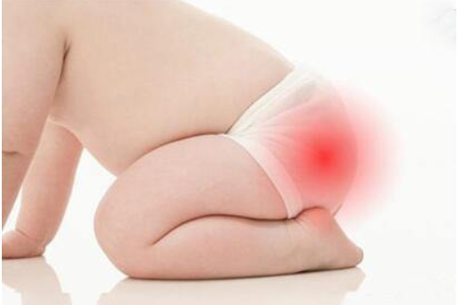 嬰兒紅屁股怎樣好得快 嬰兒紅屁股怎么辦