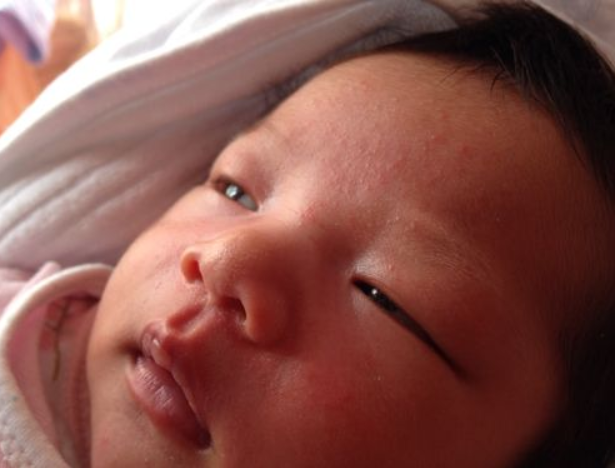 哪些寶寶容易得濕疹 如何預防寶寶長濕疹