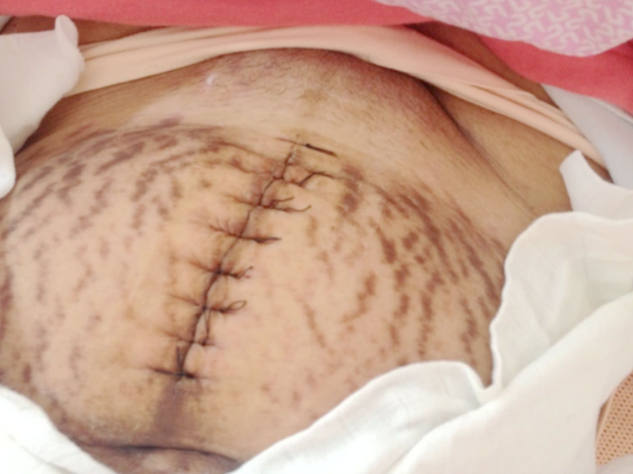 剖腹產(chǎn)橫切還是豎切好 剖腹產(chǎn)橫切豎切優(yōu)缺點(diǎn) 剖腹產(chǎn)橫切還是豎切好 剖腹產(chǎn)橫切豎切優(yōu)缺點(diǎn)