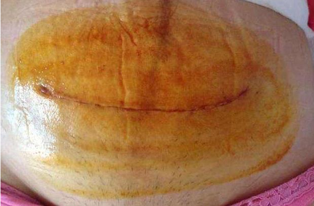 剖腹產(chǎn)橫切還是豎切好 剖腹產(chǎn)橫切豎切優(yōu)缺點(diǎn) 剖腹產(chǎn)橫切還是豎切好 剖腹產(chǎn)橫切豎切優(yōu)缺點(diǎn)