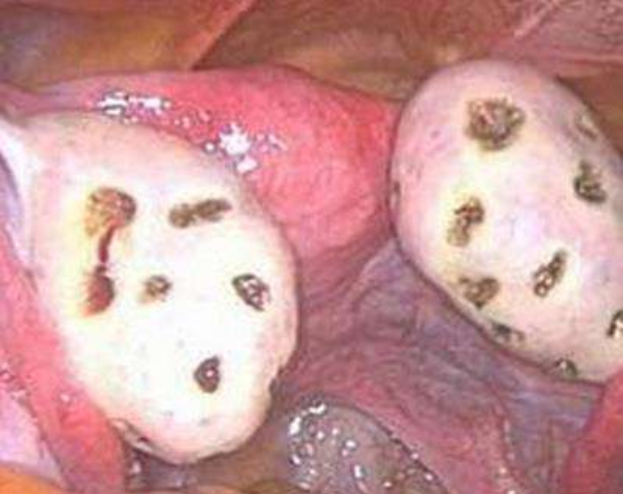 多囊懷孕幾率大嗎 多囊懷孕需要注意什么