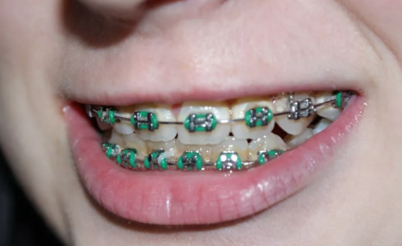 孩子牙齒不齊什么原因  孩子牙齒不齊的原因