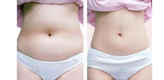 抽脂的危害有哪些 這些要注意了 抽脂的危害有哪些 這些要注意了