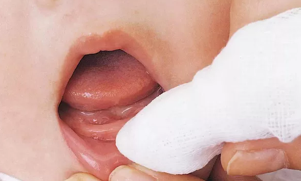 孩子牙齒斷了怎么辦  牙齒外傷注意事項