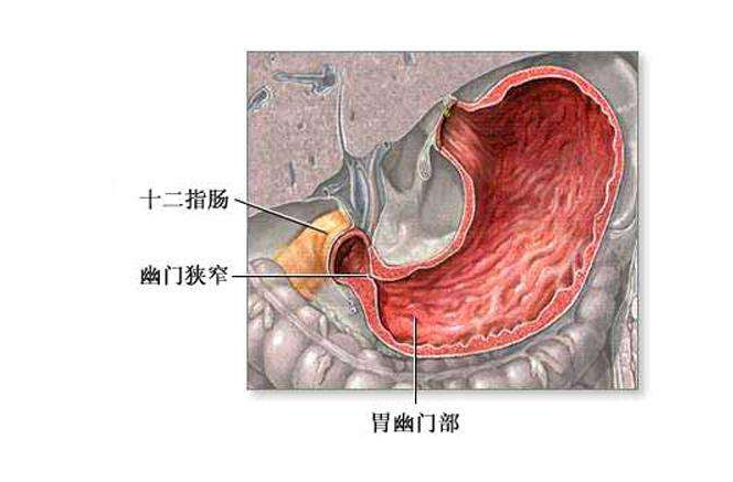 新生兒幽門狹窄嚴重嗎 新生兒幽門狹窄如何治療