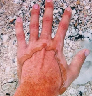 爸爸割皮救女 孩子被燙傷該怎么辦