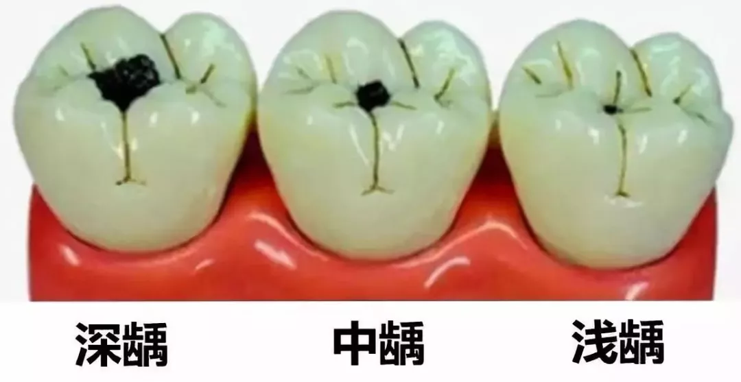 怎么保護(hù)乳牙比較好 窩溝封閉如何操作才安全