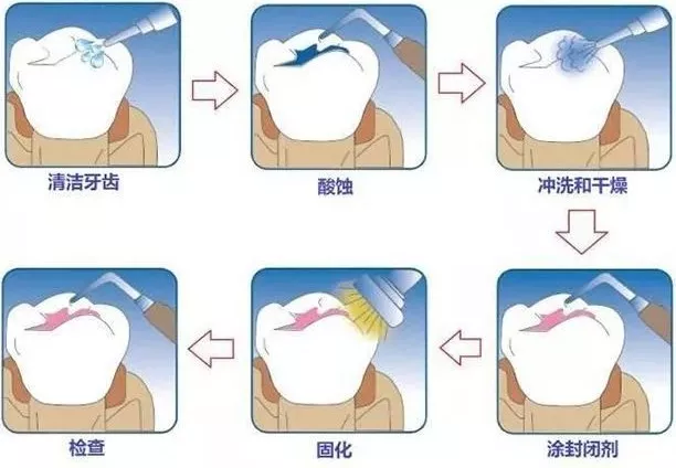 怎么保護(hù)乳牙比較好 窩溝封閉如何操作才安全