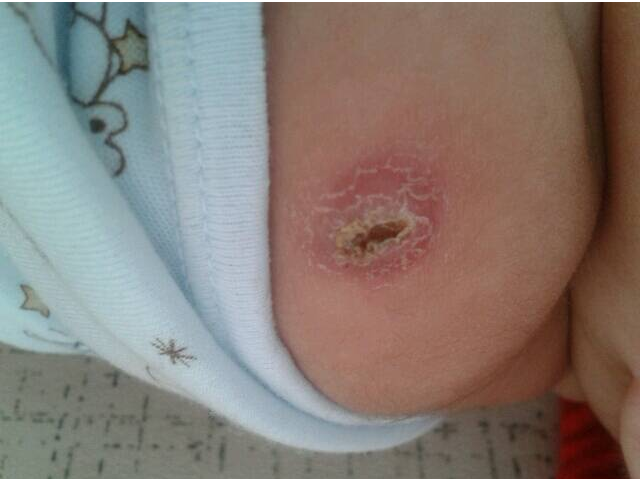 寶寶打完卡介苗可以洗澡嗎 卡介苗化膿怎么護理