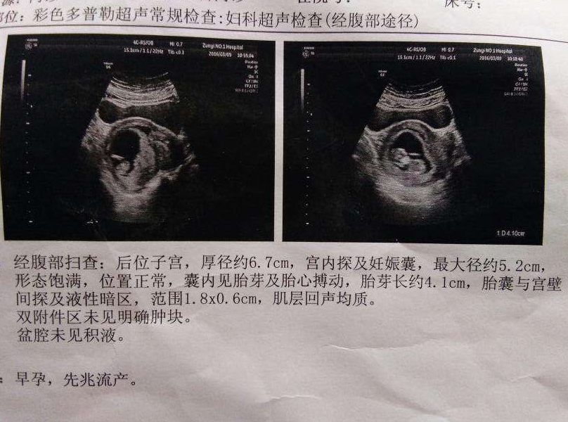 先兆流產就是流產嗎 孕期出現先兆流產癥狀怎么保胎