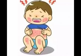 痱子和濕疹的區(qū)別 如何防治痱子和濕疹