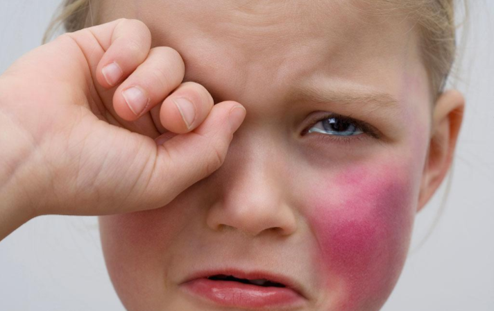 寶寶臉腫脹是得了流行性腮腺炎嗎 寶寶得流行性腮腺炎有什么癥狀