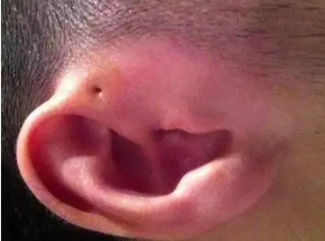 寶寶耳朵上有個小孔是怎么回事 耳朵上的小孔嚴重嗎 寶寶耳朵上有個小孔是怎么回事 耳朵上的小孔嚴重嗎