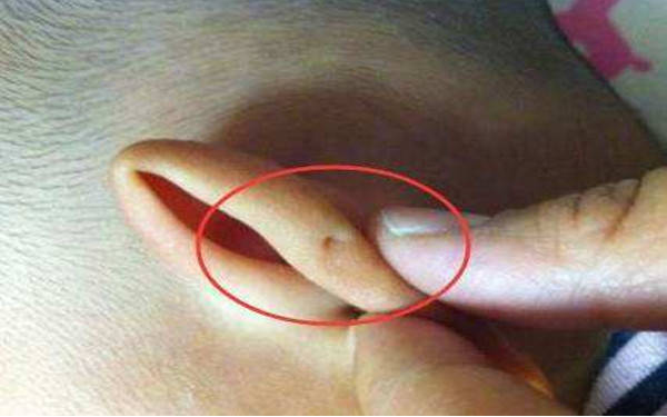 寶寶耳朵上有個小孔是怎么回事 耳朵上的小孔嚴重嗎 寶寶耳朵上有個小孔是怎么回事 耳朵上的小孔嚴重嗎