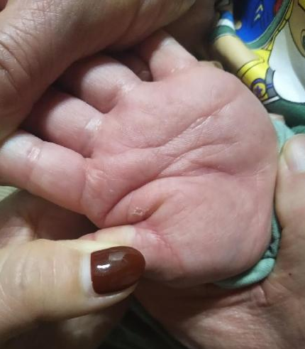 寶寶吃哪些東西最容易過敏 避免孩子過敏有什么方法