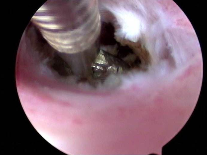 子宮粘連帶對胎兒有影響嗎 懷孕后發現子宮粘連怎么辦