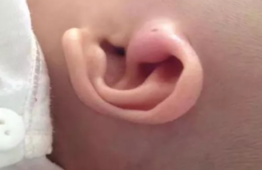 寶寶耳朵邊有個小孔是什么 耳朵邊小孔注意事項